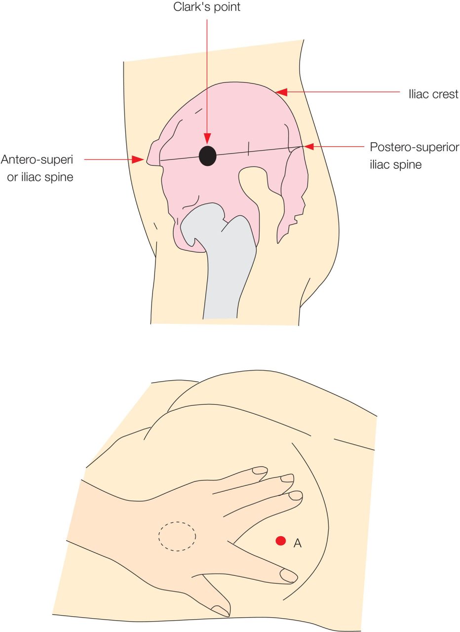 Ventrogluteal Intramuscular Injection Model