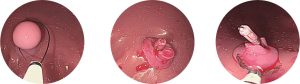 Esophago-Gastro-Duodenoscopy (EGD) Simulator