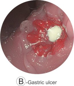 Esophago-Gastro-Duodenoscopy (EGD) Simulator