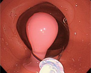 Colonoscopy (Lower GI Endoscopy) Simulator Type II
