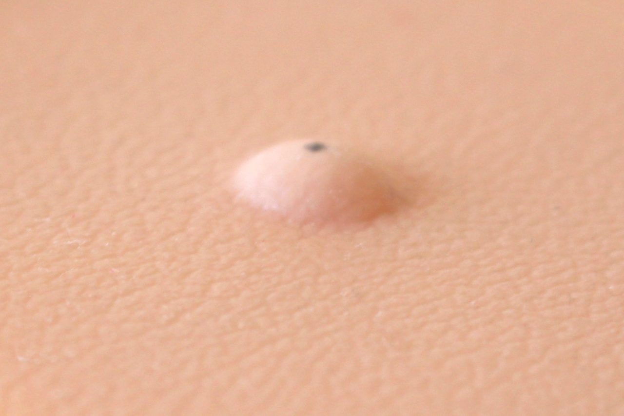 Sebaceous Cyst Pad, Light