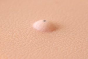 Sebaceous Cyst Pad, Light
