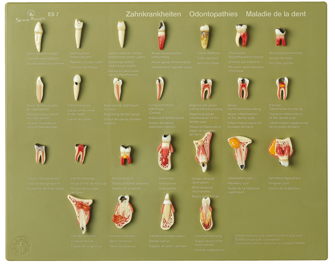 Case of Teeth “Odontopathies”