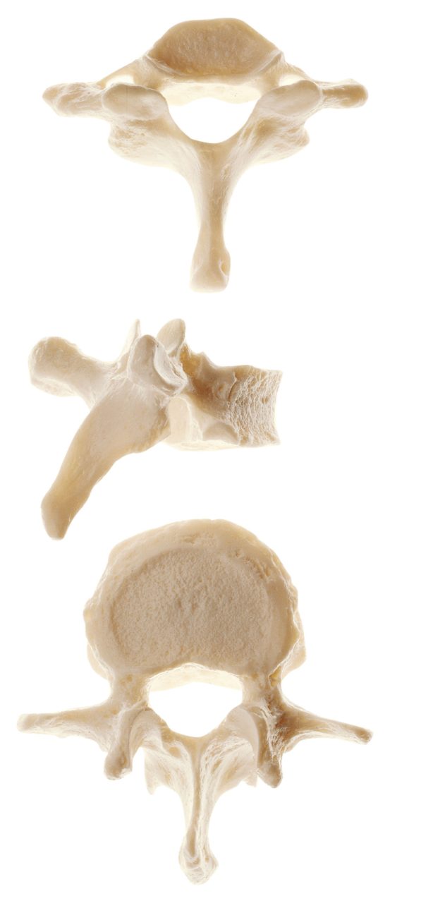 Vertebra (Cervical, Thoracic or Lumbar)
