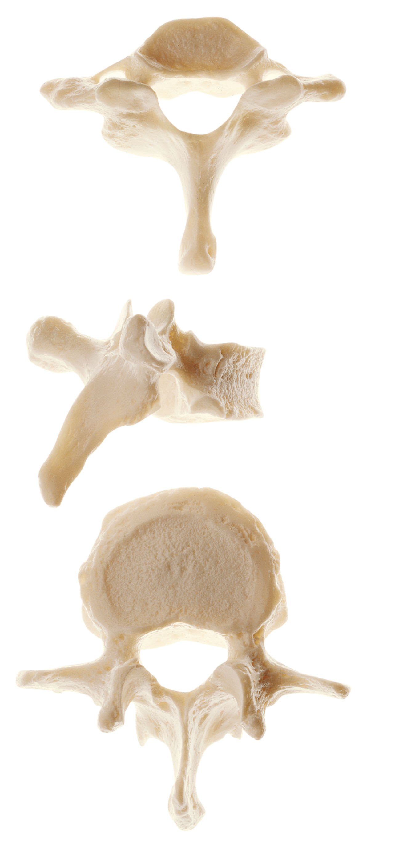 Vertebra (Cervical, Thoracic or Lumbar)