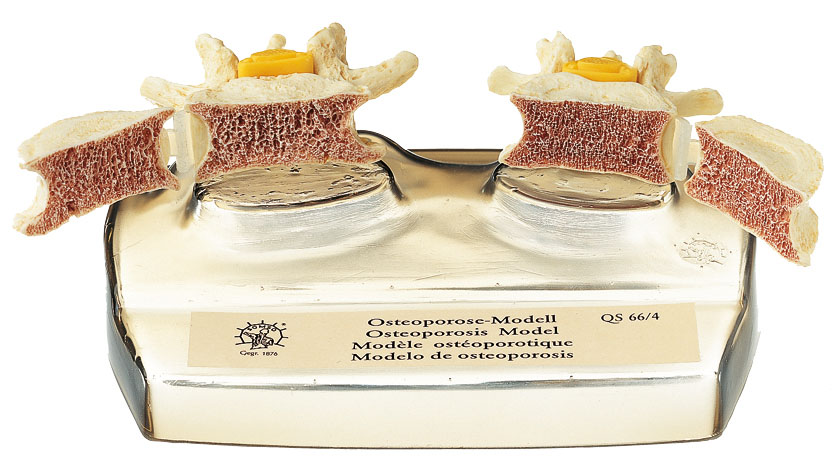 Osteoporosis Model