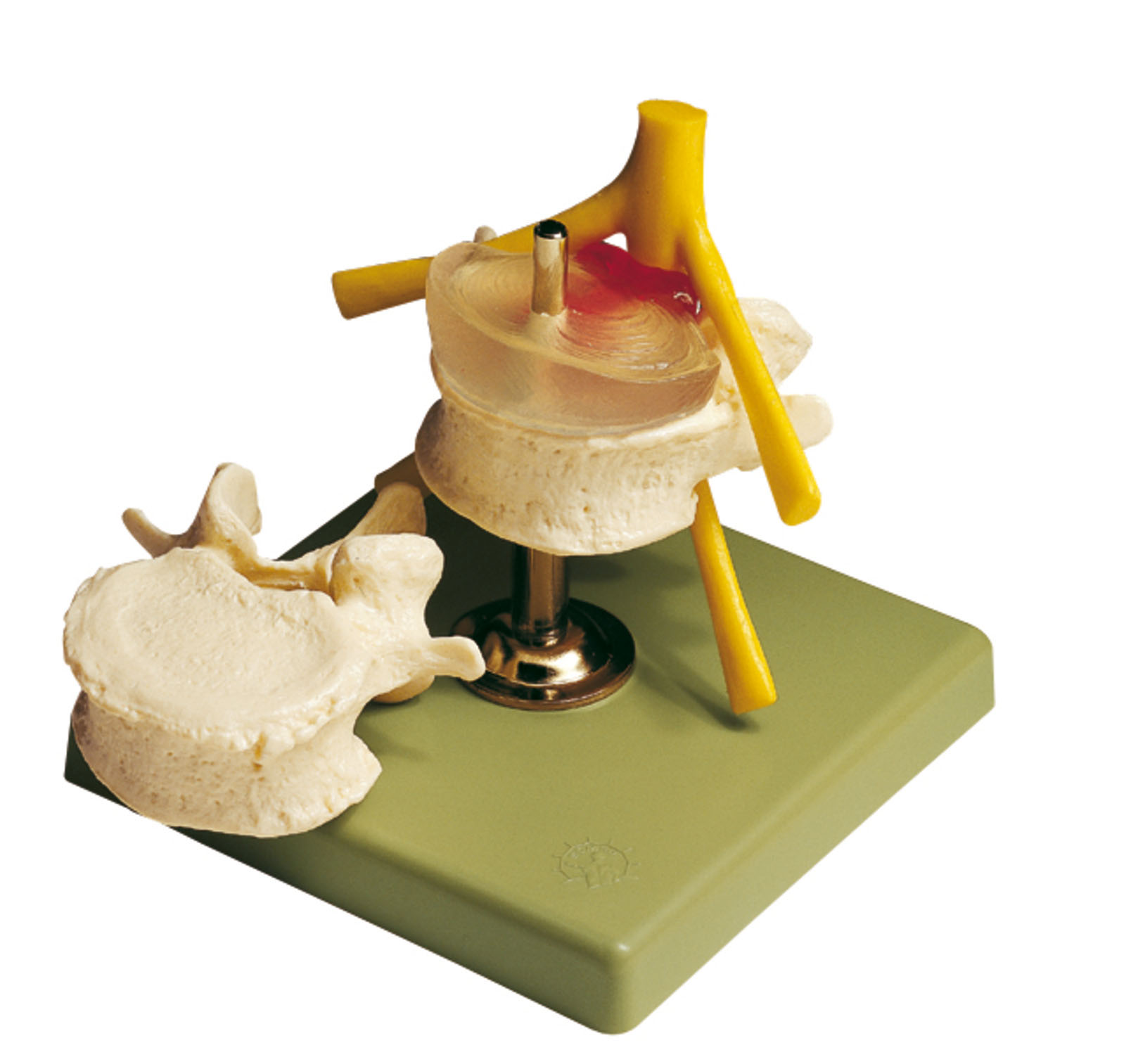 Hernia of Central Intervertebral Disc