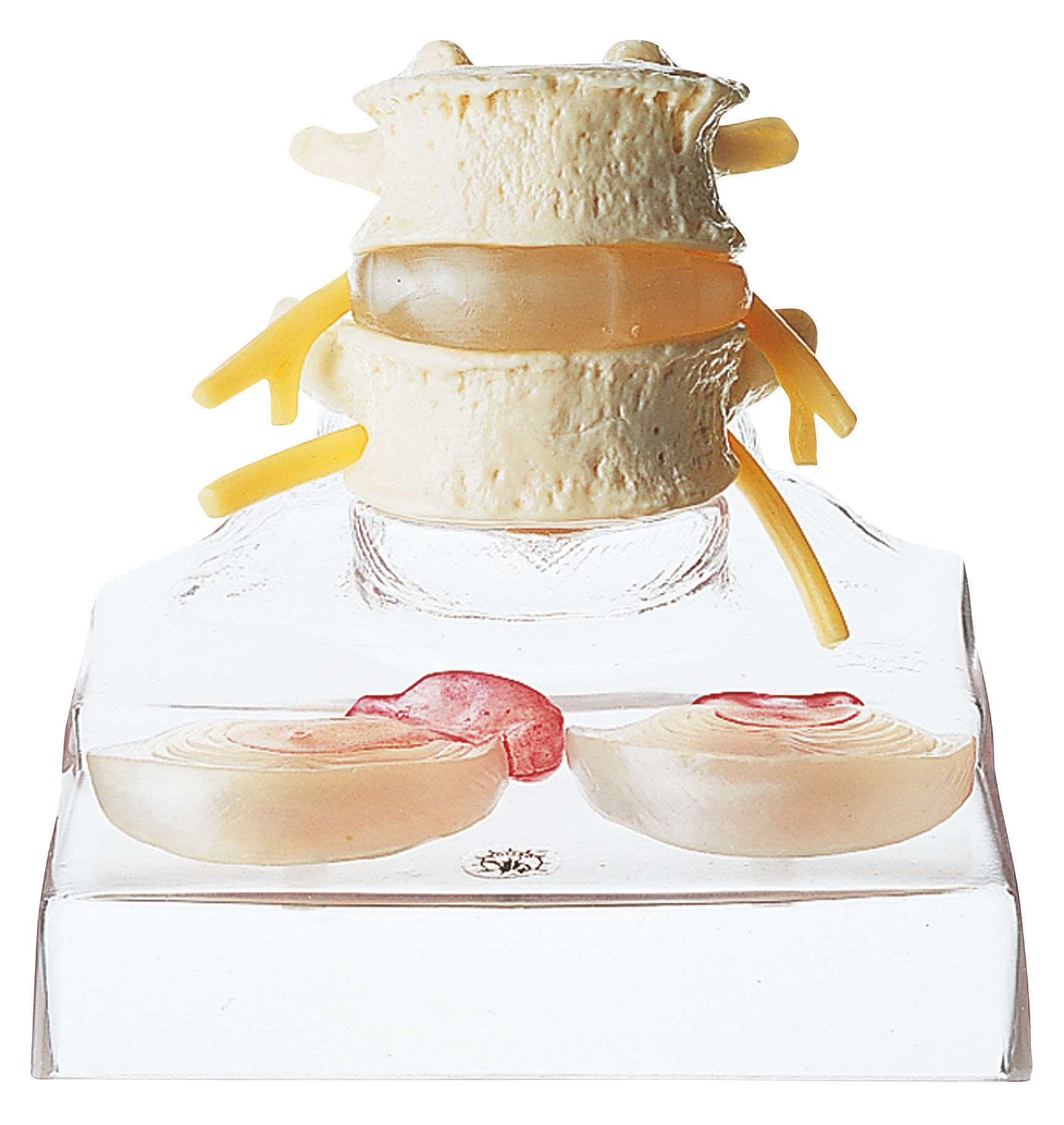 Central and Dorsolateral Herniated Disc