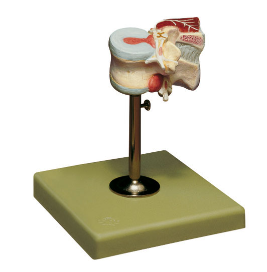First Lumbar Vertebra With Herniated Discs and Dorsal Muscles