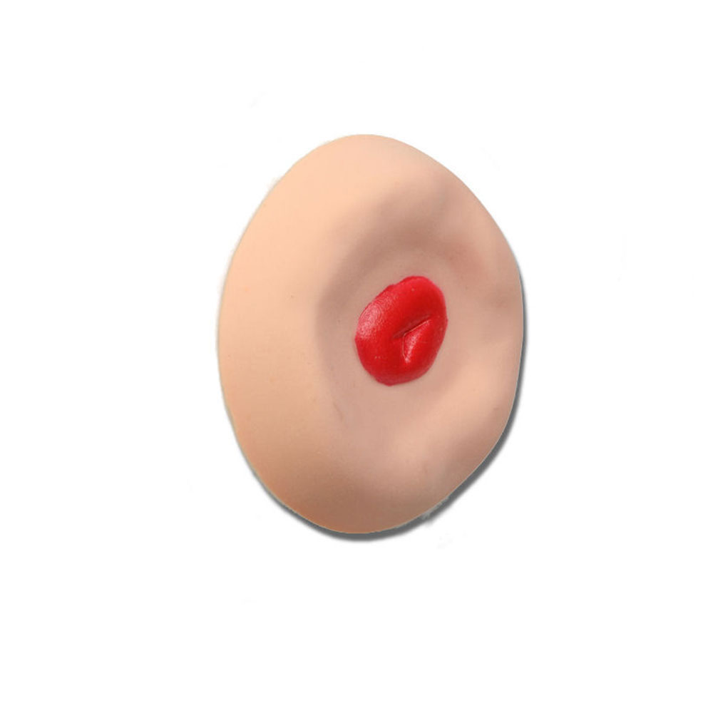 Recessed Stoma