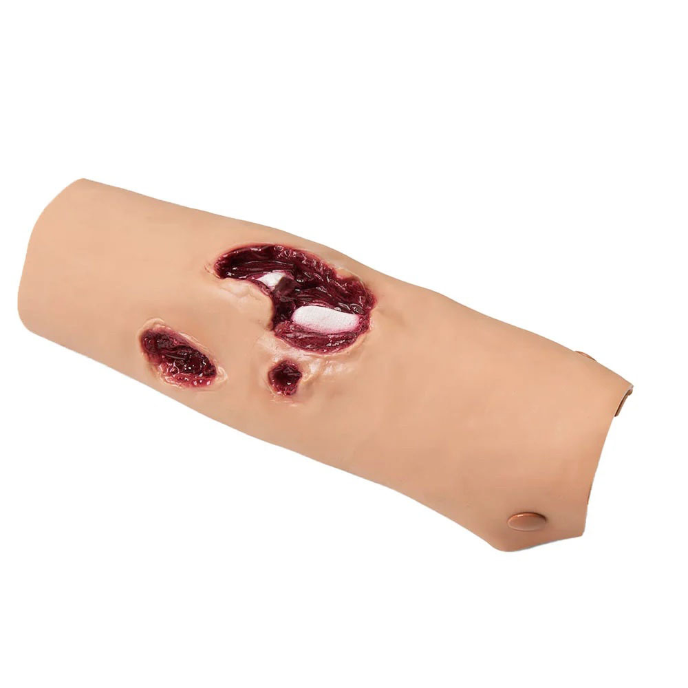 Compound Fracture Tibia