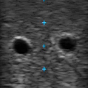 Vascular Access Ultrasound Phantom, Light