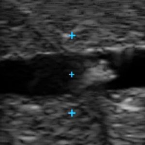 Vascular Access Ultrasound Phantom, Light