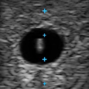 Vascular Access Ultrasound Phantom, Dark