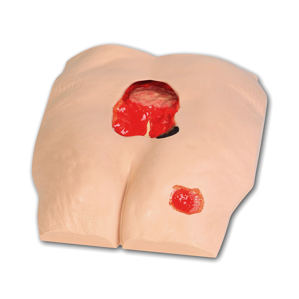 Stan™ Stage 4 Pressure Ulcer Model, Light